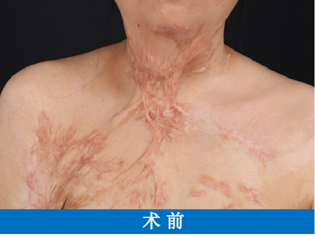 经过治疗已经康复,但是身上却留下大片烧伤疤痕,尤其是颈部疤痕粘连