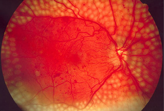 而糖尿病患者很大机会发生眼部血管受损,若长期血糖控制不佳,血管破坏