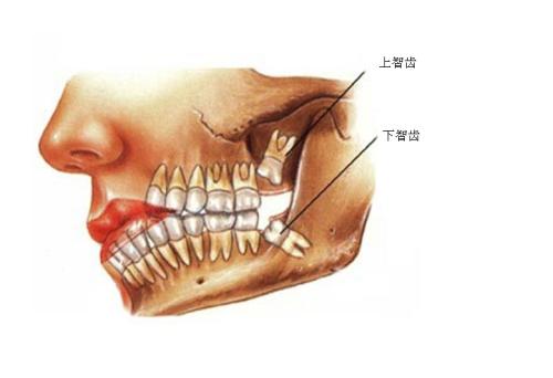 智齿长牙龈侧面上图片