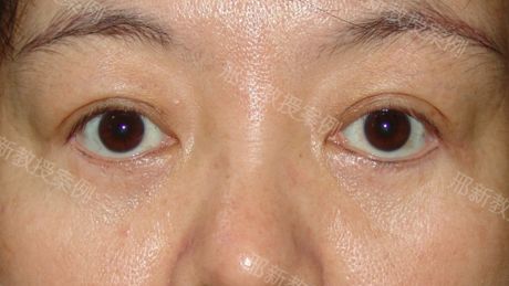 邢新下睑退缩修复案例三白眼面露凶相要怎么办