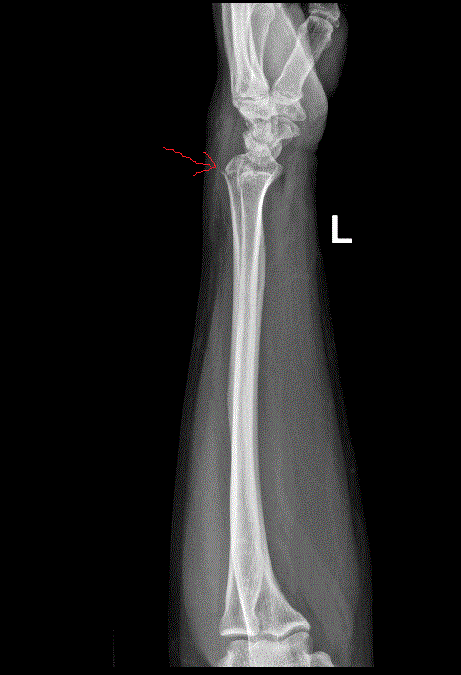 中老年人尺桡骨远端骨折1例分析