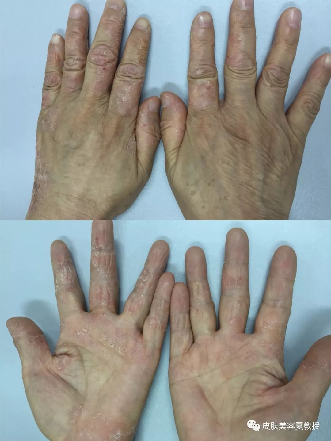 冬日谨防主妇手