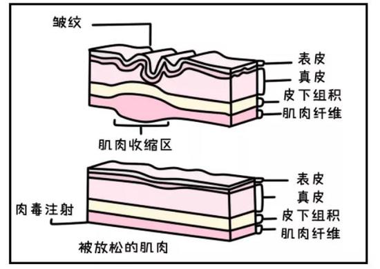 肉毒毒素 肉毒毒素是肉毒梭菌在生長繁殖過程中產生的一種細菌外毒素