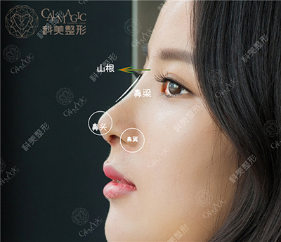 不说隆鼻的材料合适与否,这高高隆起的与鼻尖成一条垂直水平线的山根