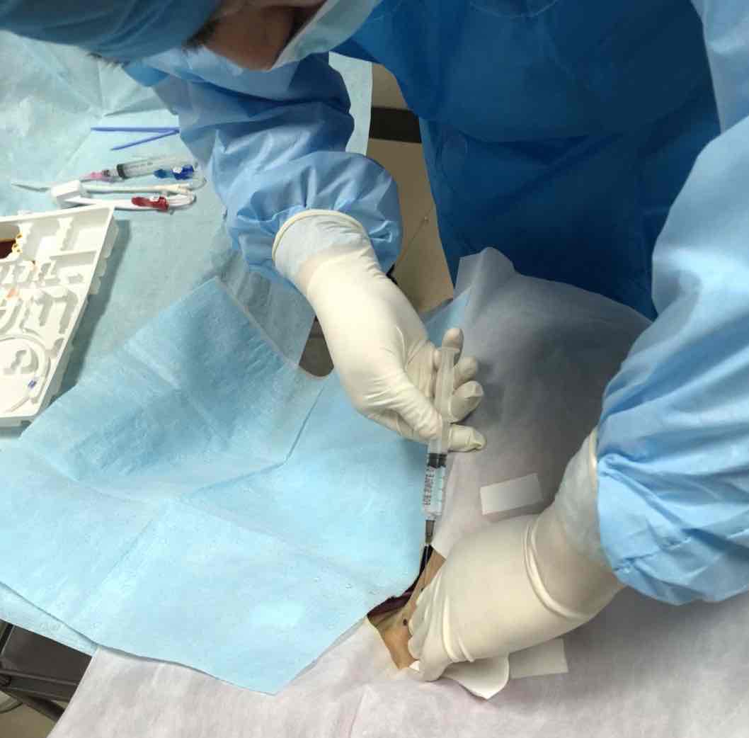 深静脉置管(透析用)