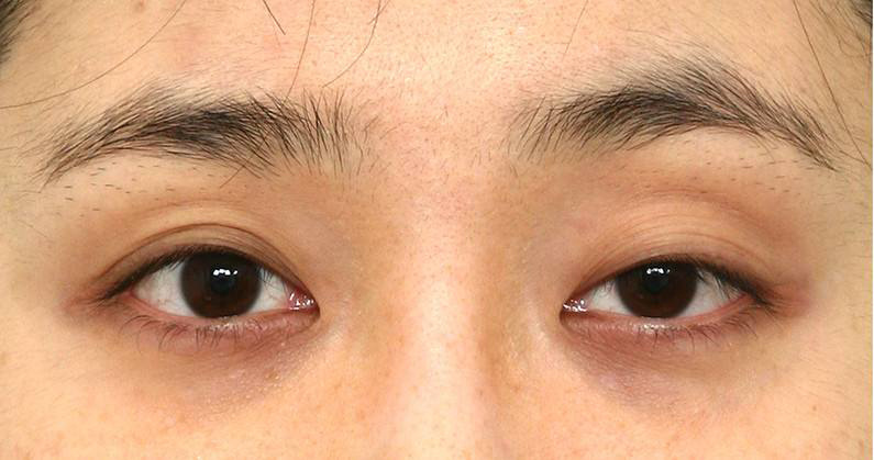 哪些人适合做双眼皮手术