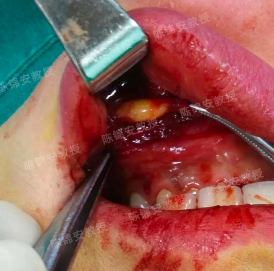 案例分享 | 下颏部不明注射物是如何成功取出的?