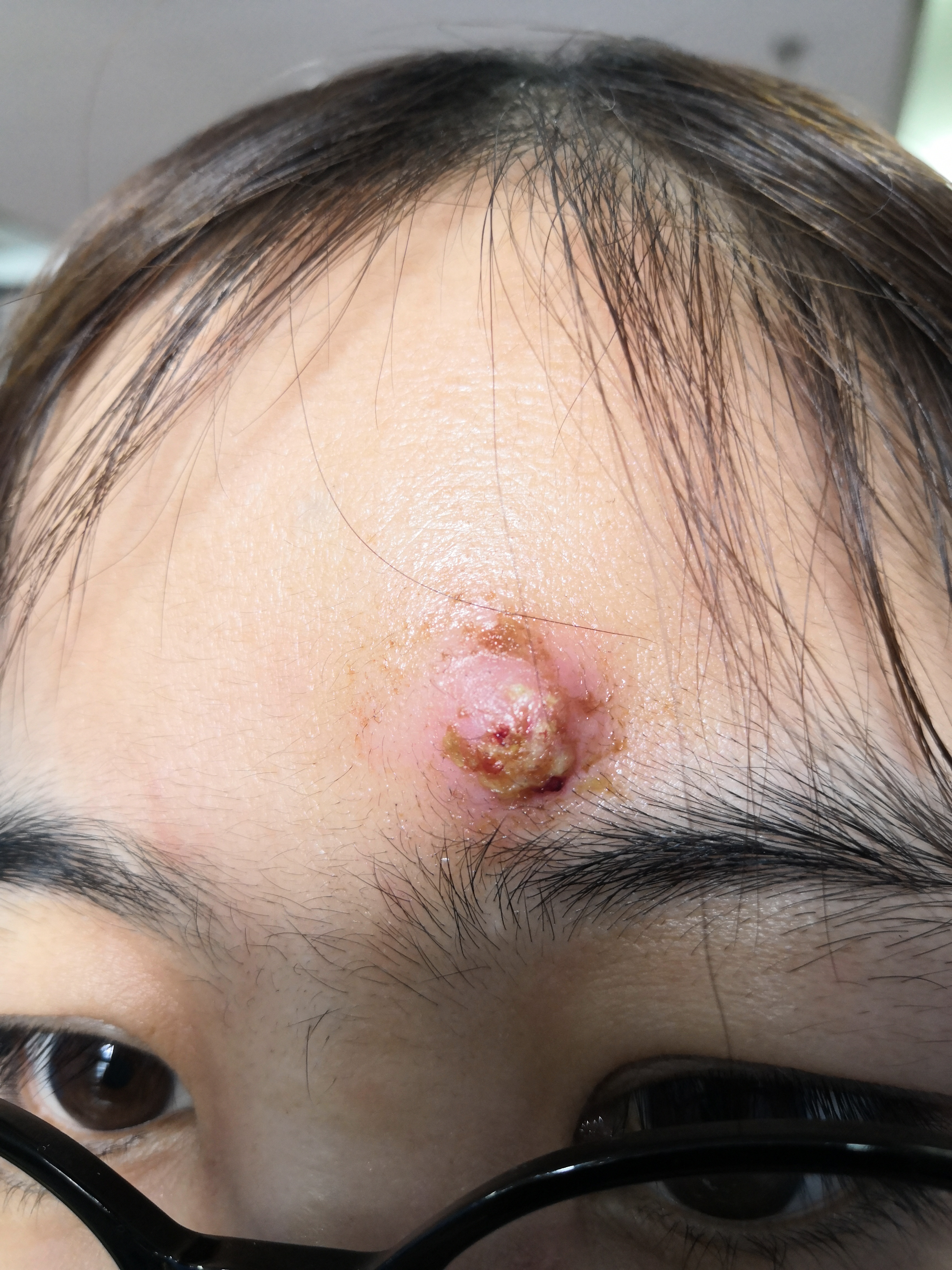 脸上痘痘不要挤