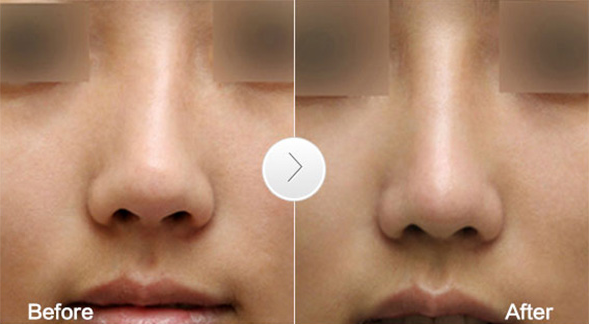 很多人隆鼻后觉得鼻子歪了?那到底有没有歪?鼻歪了该如何修复?