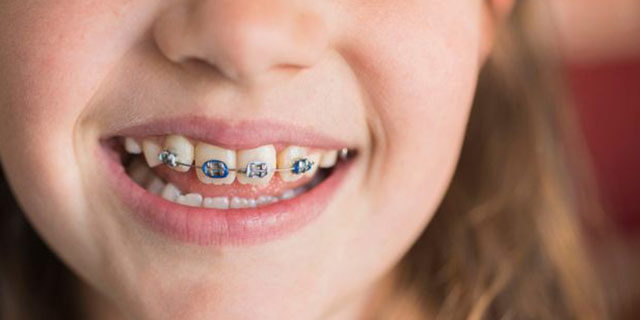 1活动矫治器:一般常用于乳牙和替牙期的比较简单的错合畸形的矫正