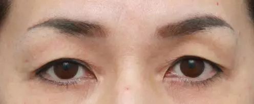 上睑皮肤松弛该怎么办?