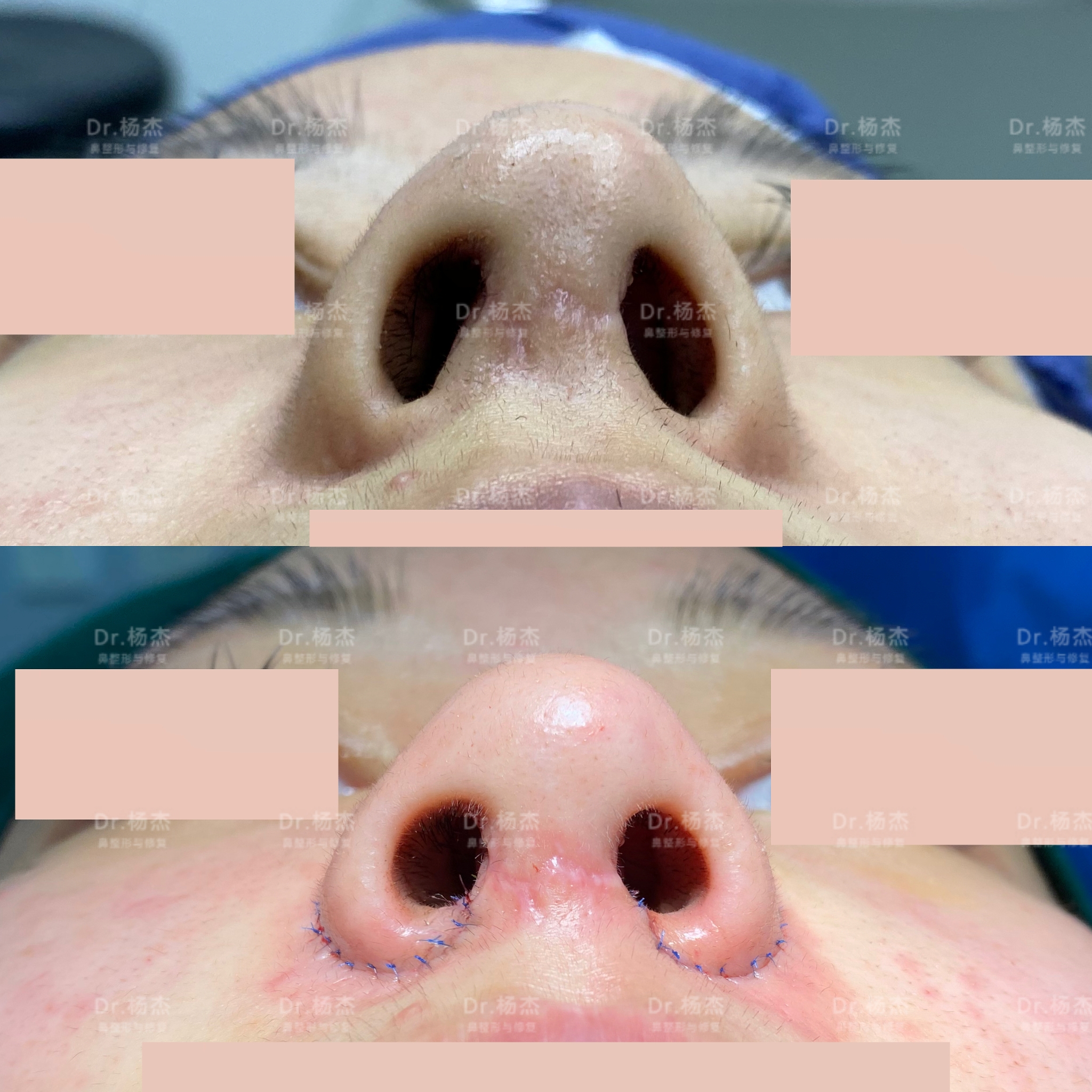 手术采取鼻翼外切:1,改善鼻基底凹陷:经鼻翼外切手术切口,分离鼻基底