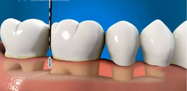 深度图解:牙周治疗—龈下刮治术