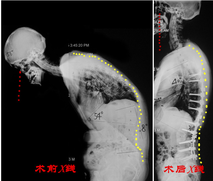 告別駝背挺直腰桿聆聽強直性脊柱炎伴後凸患者的心聲