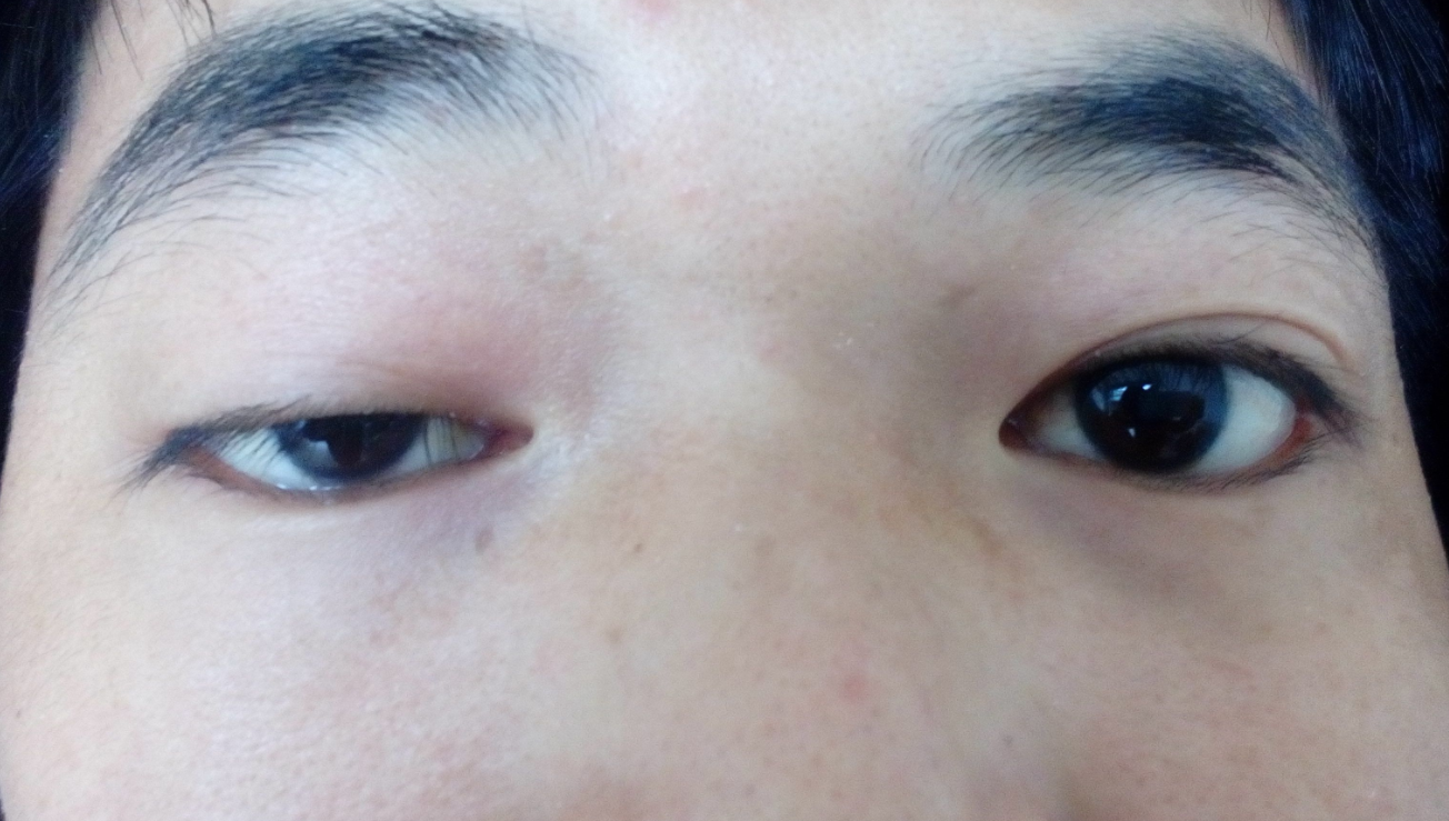 整形医生林威说:上睑下垂的双眼皮