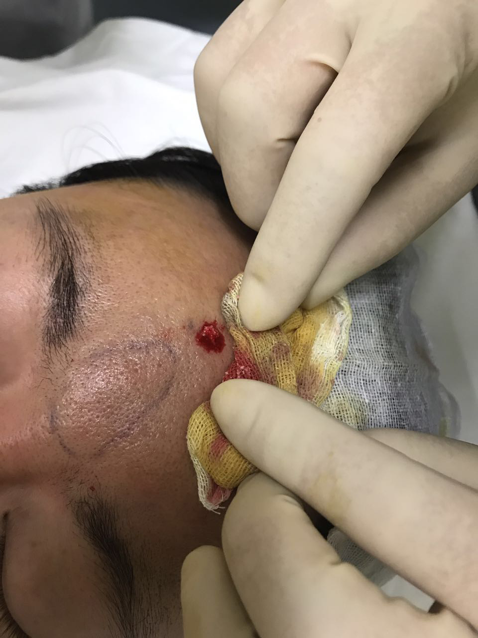 实拍异物取出注射填充物慎用微晶瓷