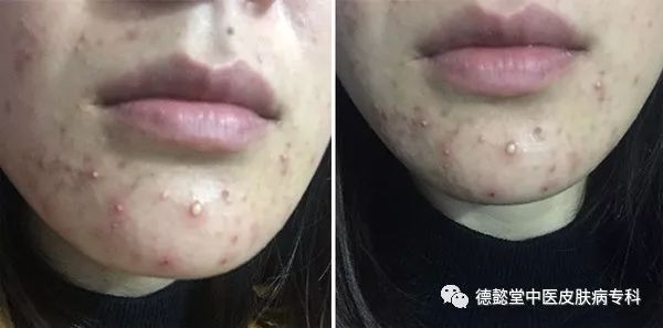 你知道为啥肺胃热易长痘,气滞血瘀爱长斑吗?