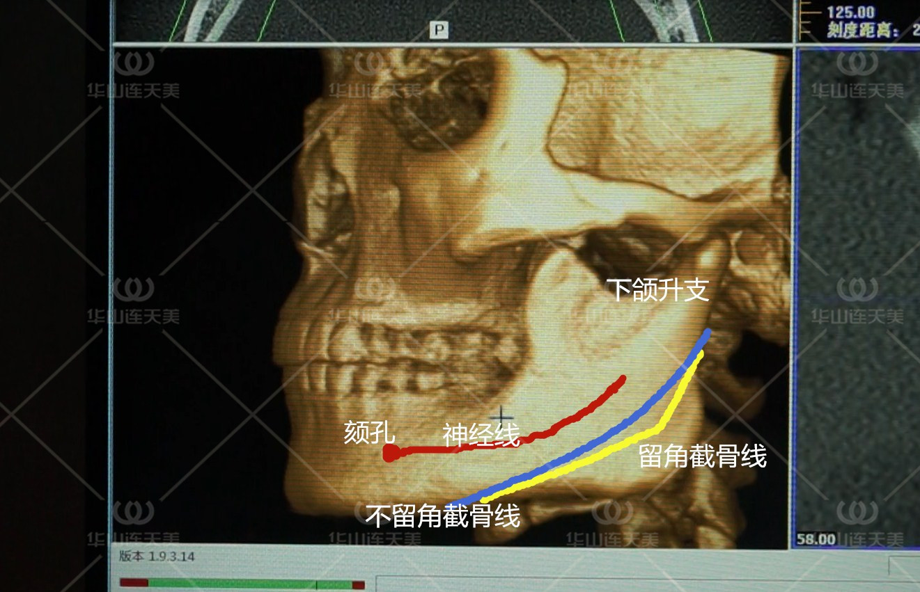 什麼樣的下頜角適合留角截骨?