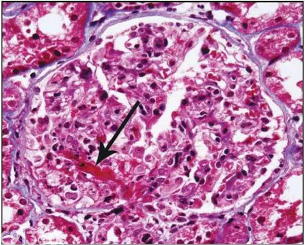 新月体性iga肾病的症状表现-王培顺副主任医师-爱问医生