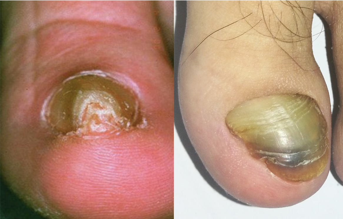 pincer nail (卷曲甲)