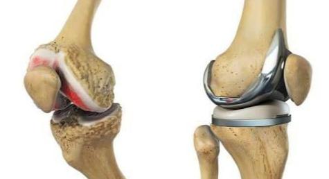 膝关节置换手术,康复锻炼很重要,需趁早,术前就应准备好