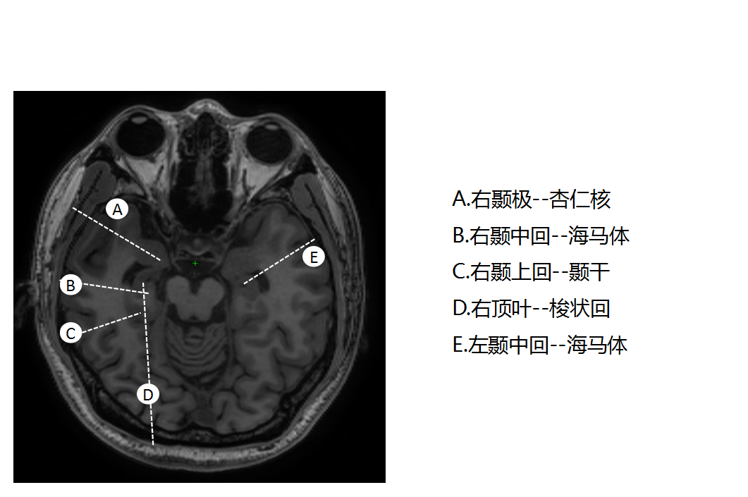 杏仁体位置图片