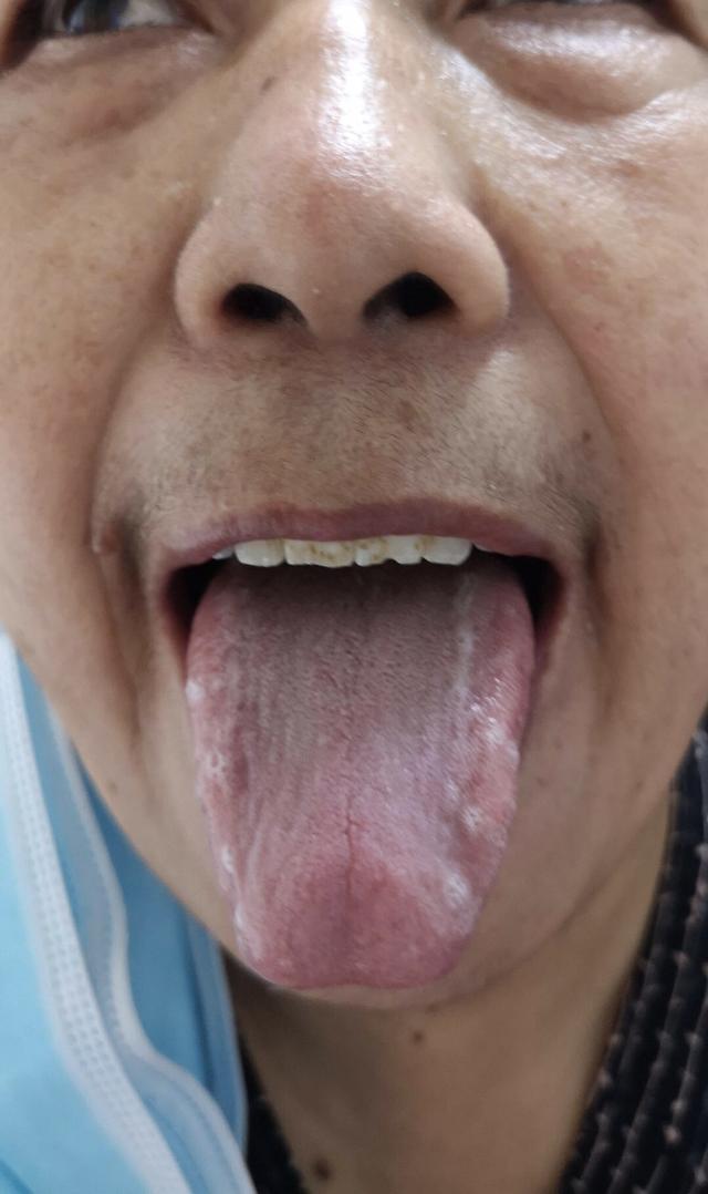 图为郭女士复诊时舌苔