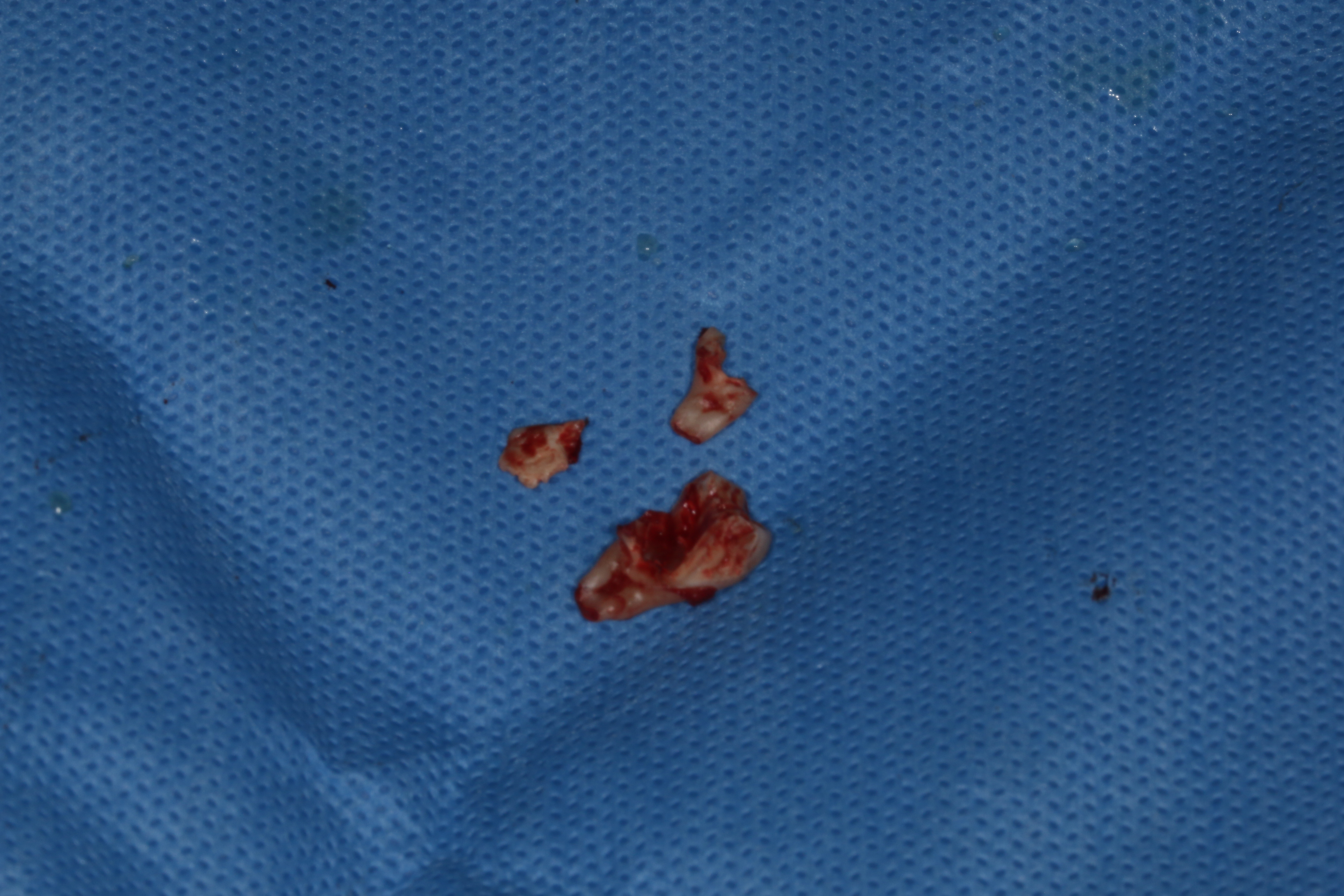 多根埋伏智齿拔出