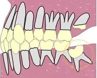 吐舌习惯,张口呼吸等都会导致骨骼和牙齿的错颌畸形,所以也应及时来