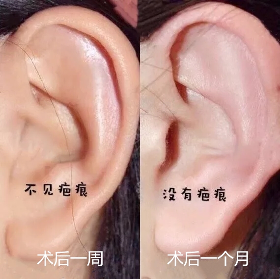 耳软骨隆鼻会被吸收吗?