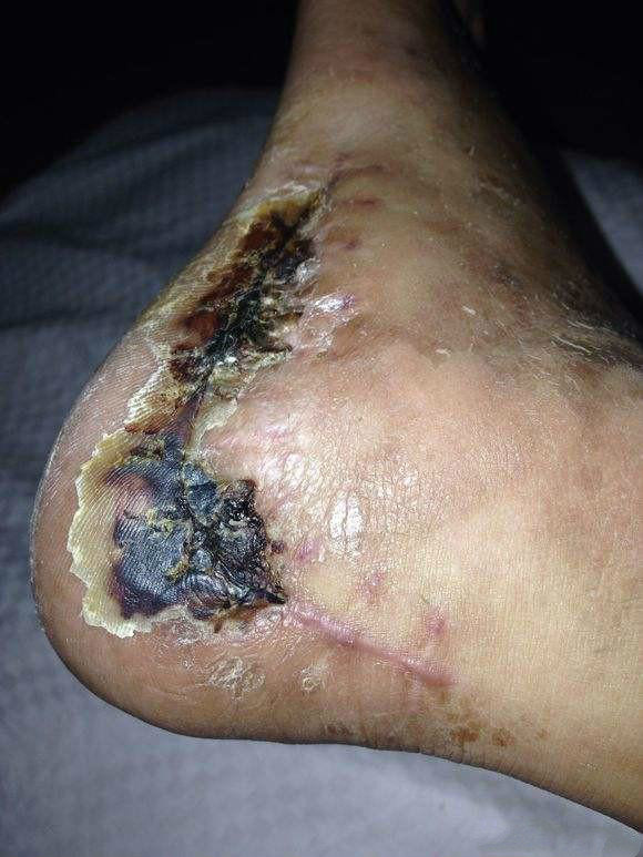 骨折手术后吸烟的坏处!不仅多花钱还多受罪