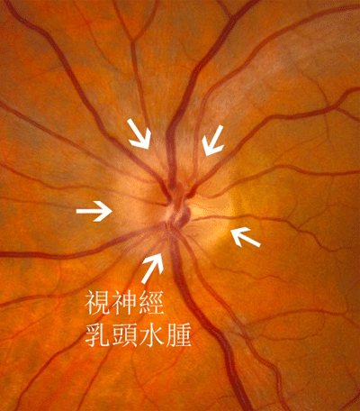 视神经萎缩-视力的"绝症"