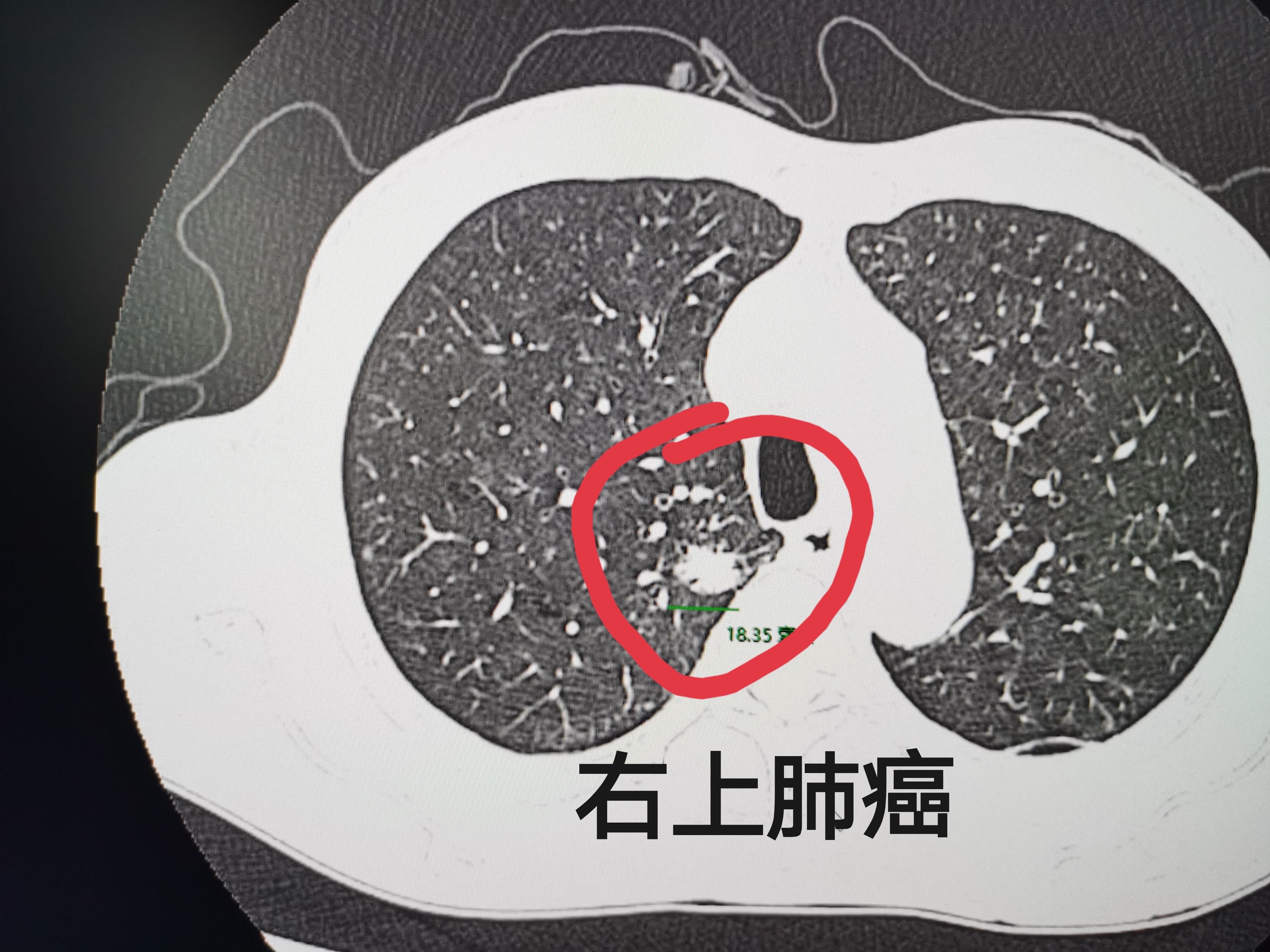 出车祸断了四根肋骨,却因此救回一命,不是开玩笑吧?