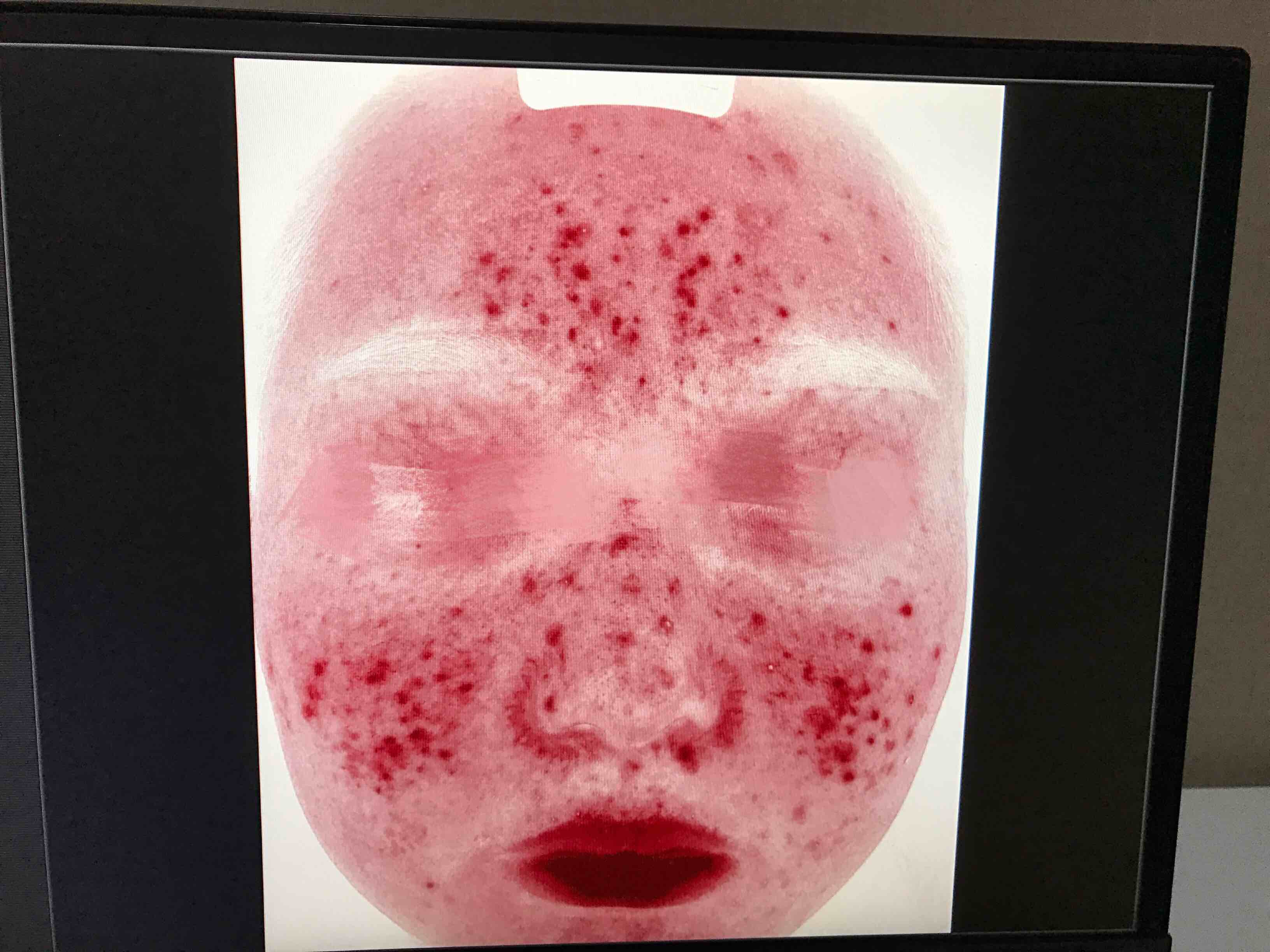 玫瑰痤疮不是痘-屈新华副主任医师-爱问医生