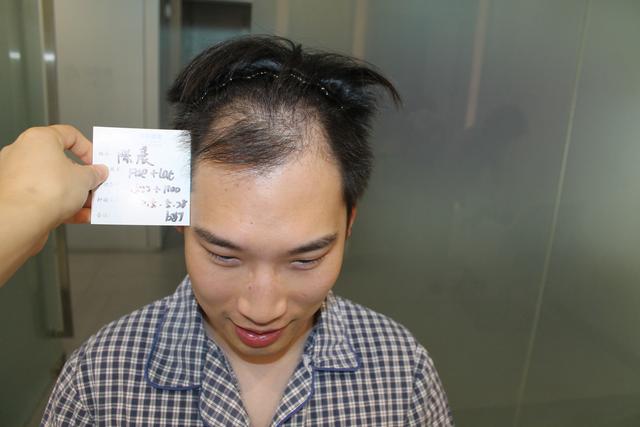 (末尾插一组雍禾的植发发友效果图,对比变化还是很大的.