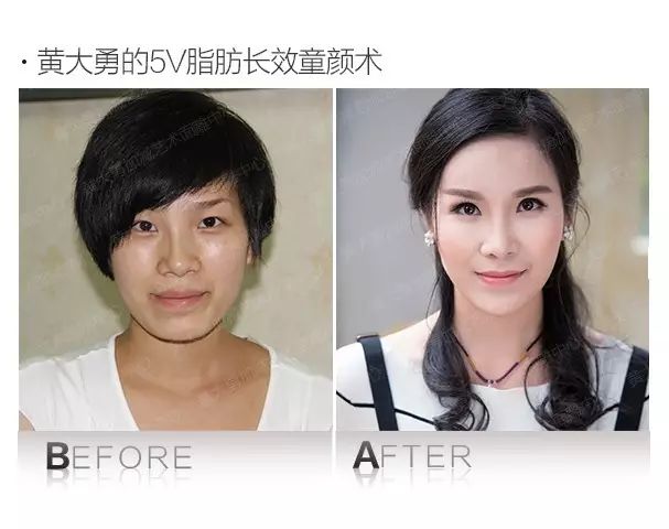 练就完美侧颜杀, 你可能只差一个饱满的额头!