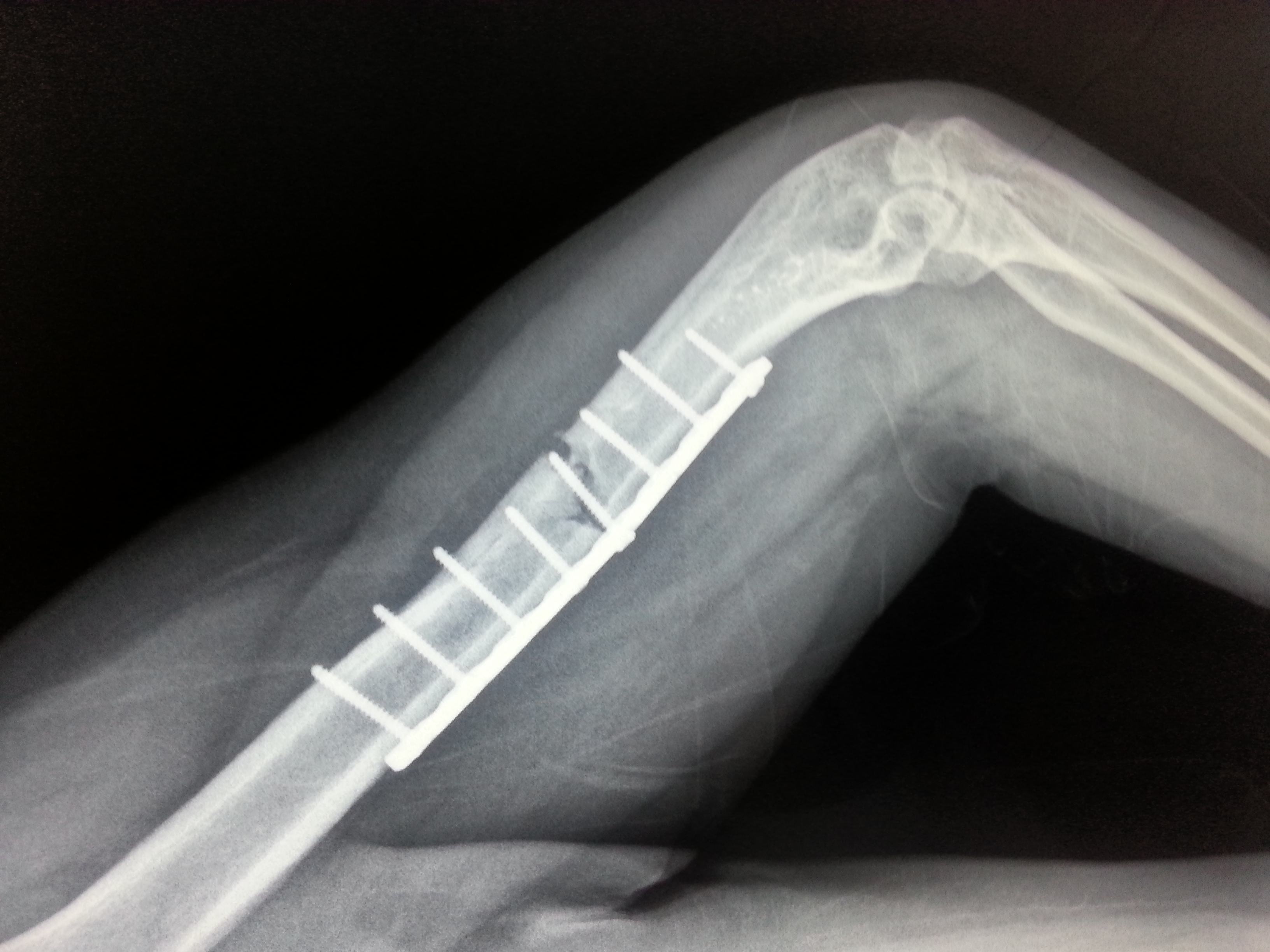 但是除了骨头断了,骨折的分类?骨折后的症状?骨折需要做什么检查?