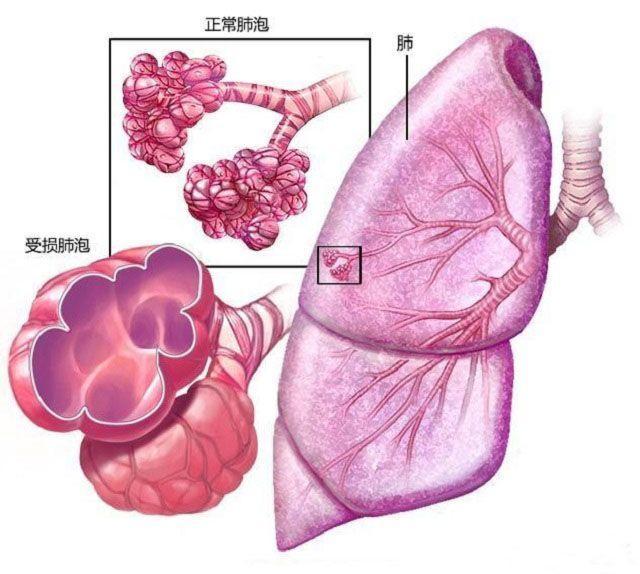 慢支和肺氣腫是很遭罪的病,醫生提醒:做好6點,咳喘無影蹤