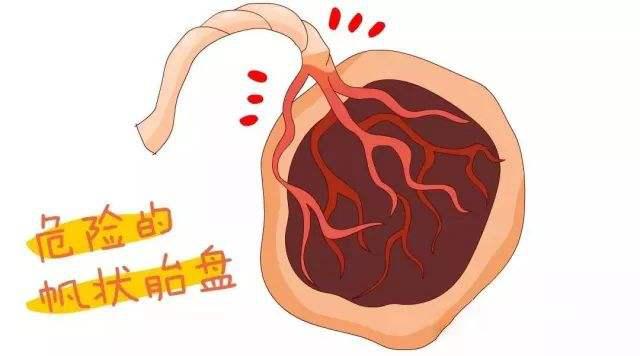 所以在产检中,如果发现孕妈存在前置胎盘,帆状胎盘,副胎盘,多胎妊娠