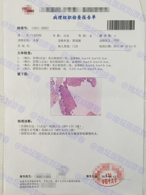 即使做了宫颈锥切,切除掉病变组织,但是hpv持续感染,最后导致阴道穹窿