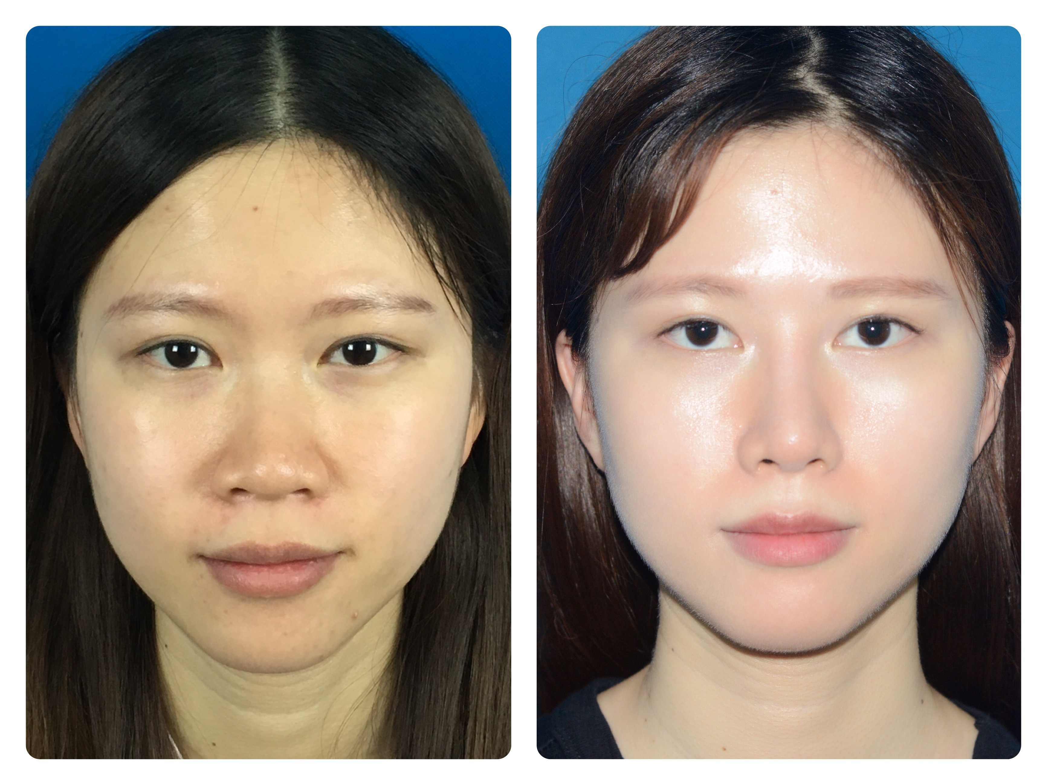 隆鼻≠综合隆鼻,99%的都选错了!