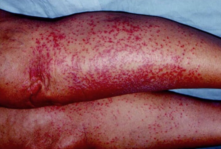 痱子的八卦科普版