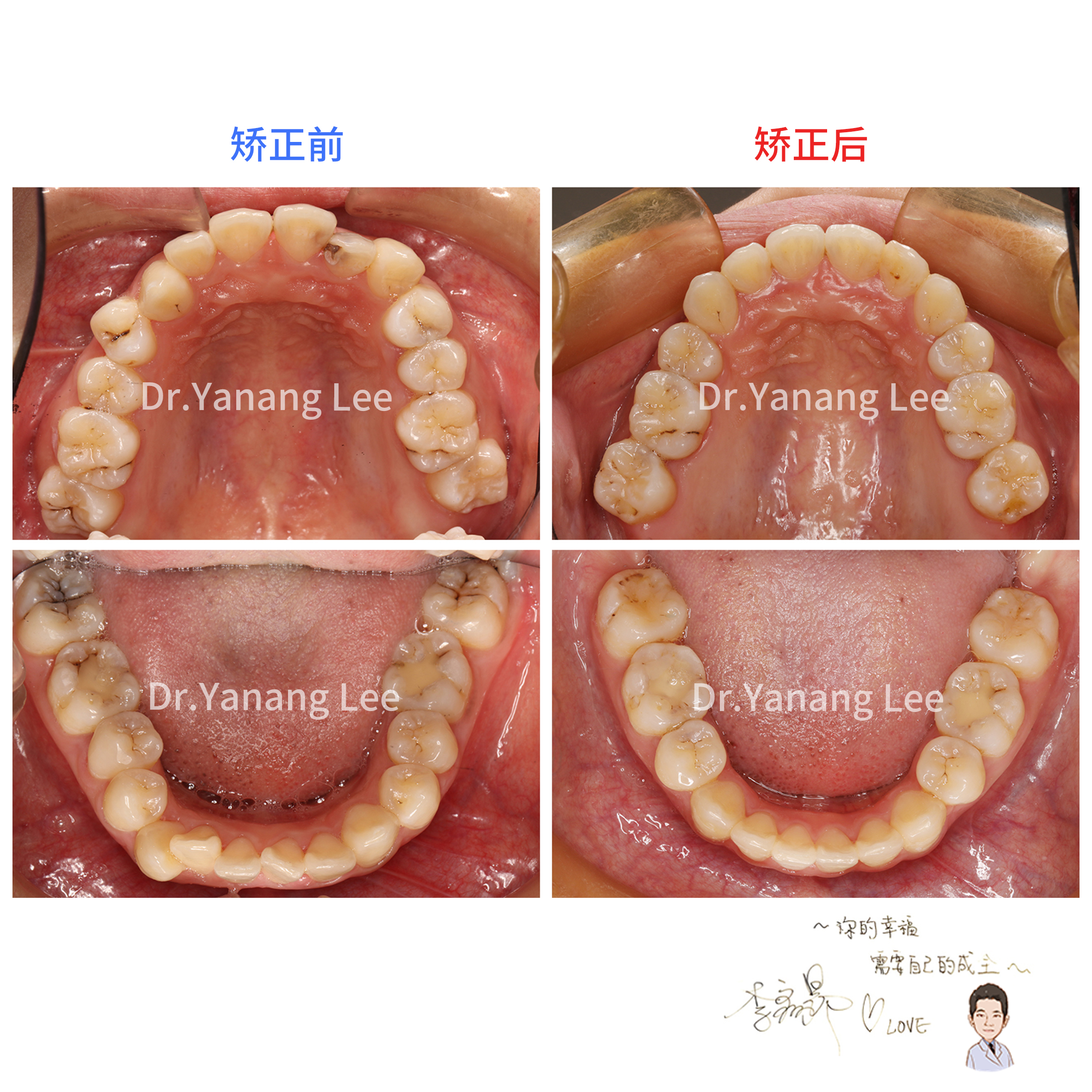 李医生通过减数四颗正畸牙获得调整空间,排齐整平上下牙列的同时,还