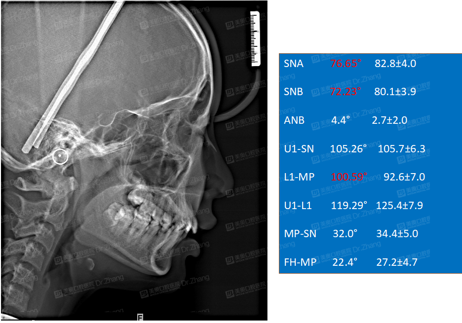 模型分析: 拥挤度:上颌2mm,下颌6mm  bolton:前牙比78.
