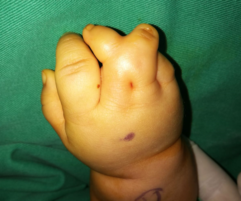 宝宝复杂并指治疗案例一