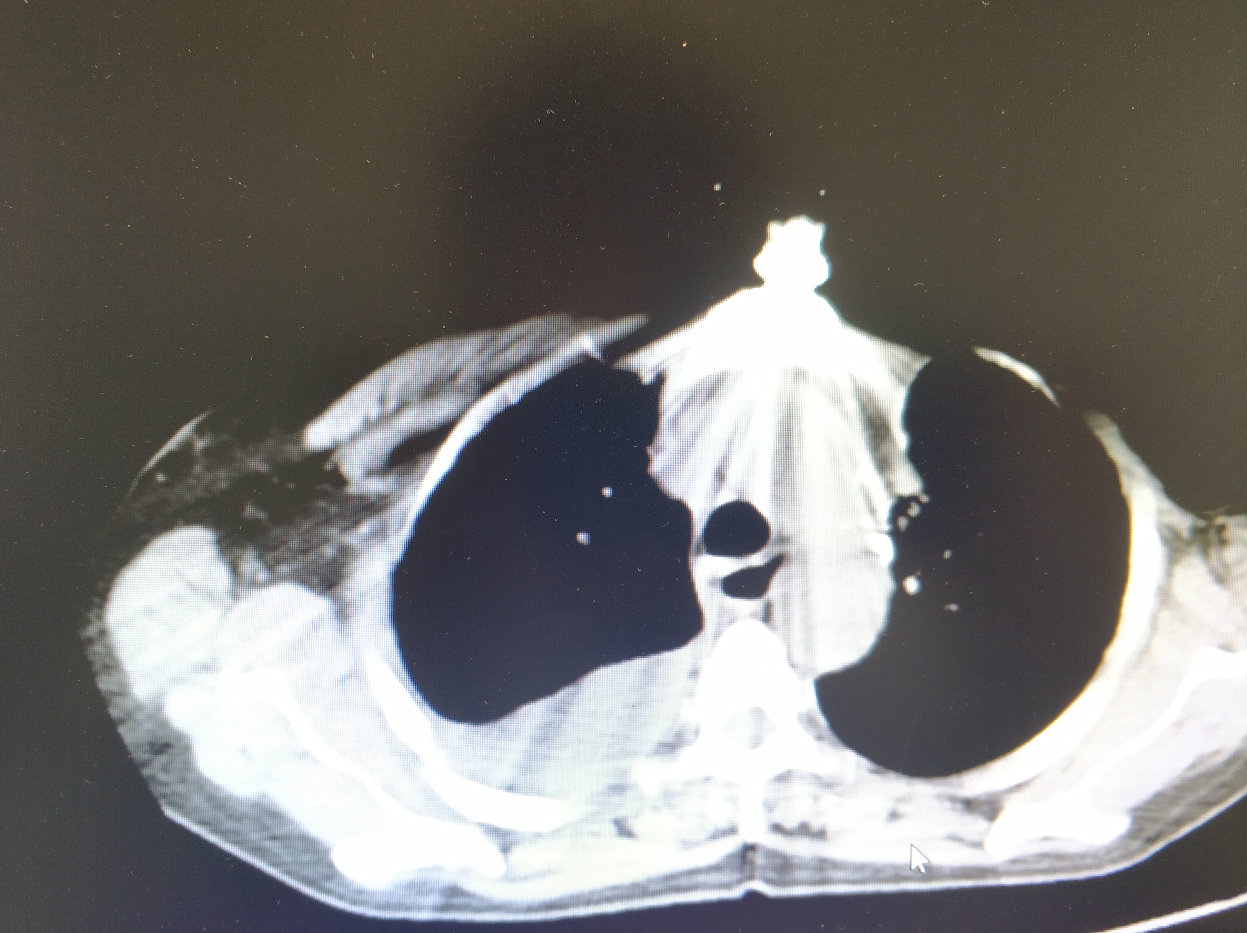 乳腺癌为什么容易向肺部转移