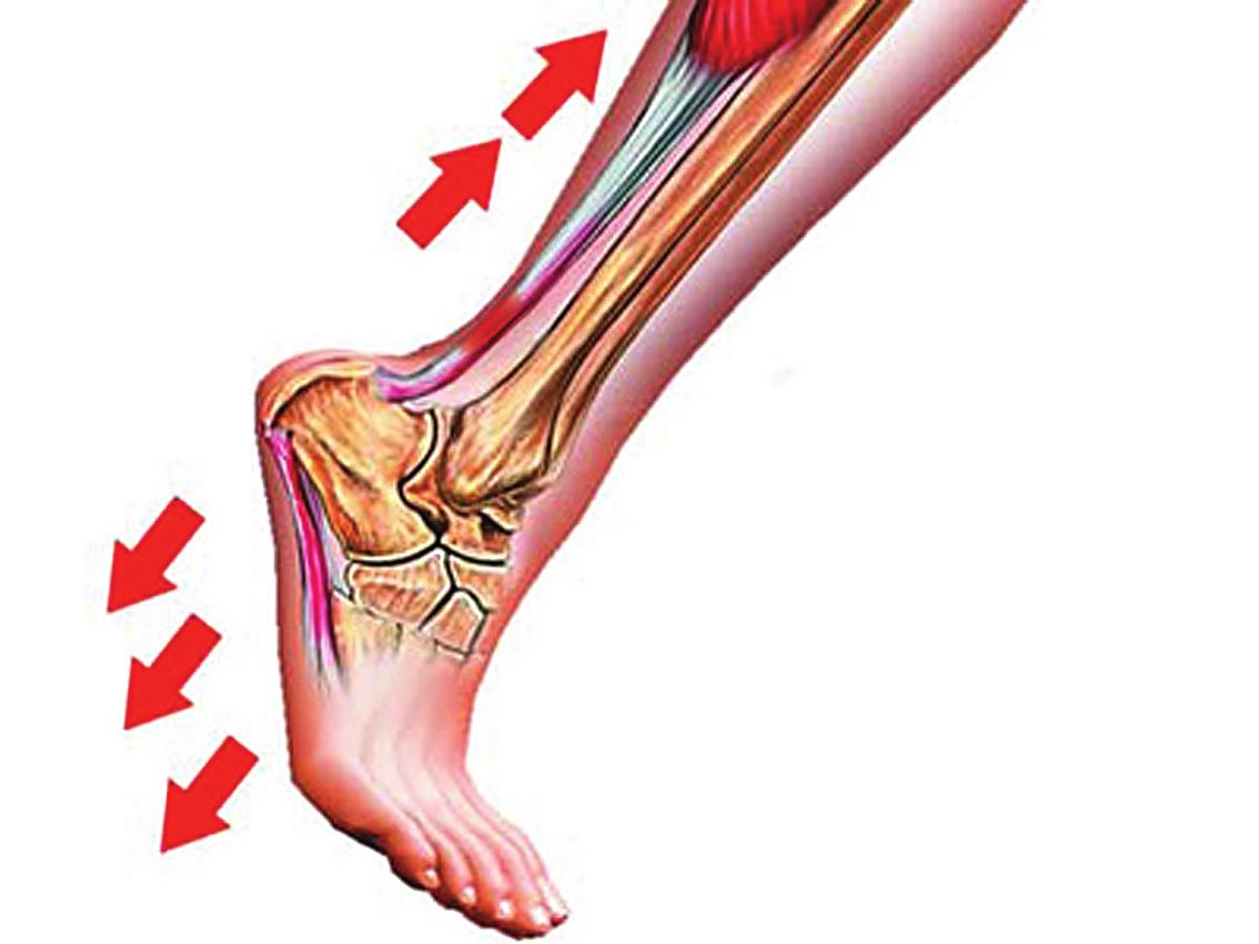 战神之踵跟痛症