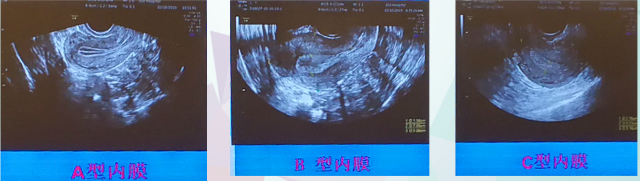 超聲子宮內膜的分型尚無統一標準,臨床上多采用gonen分型.