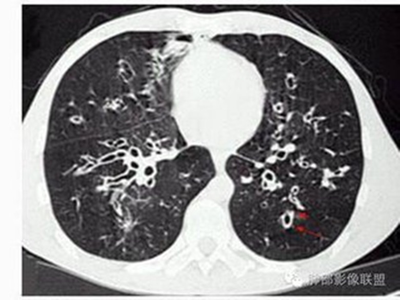中医对支气管扩张症的认识
