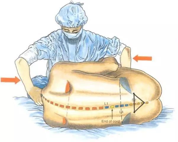 硬膜外麻醉体位图片